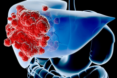 医生：请少饮用“1桶装水”，避免加速肝癌的到来，建议早了解